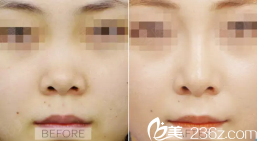 重慶新銅雀臺(tái)整形李信奎隆鼻案例