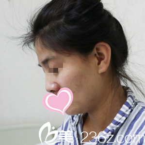 做鼻綜合術(shù)前 做鼻綜合術(shù)前