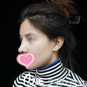 一周拆線 一周拆線