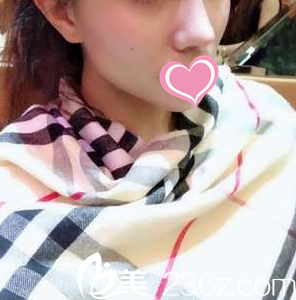 術(shù)后十五天效果 術(shù)后十五天效果