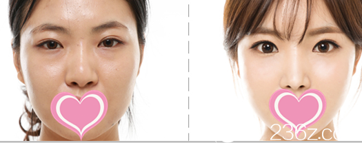 韓國(guó)希克麗整形外科醫(yī)院案例