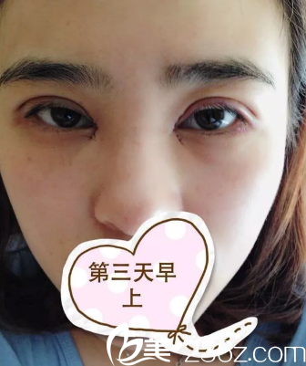 到現(xiàn)在還是很腫