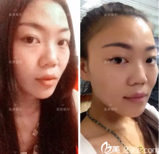 到集美做鼻修復前的元元