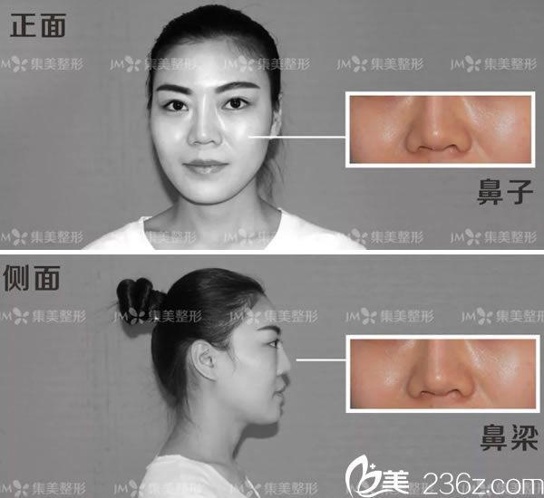 元元做鼻失敗修復手術(shù)前分析