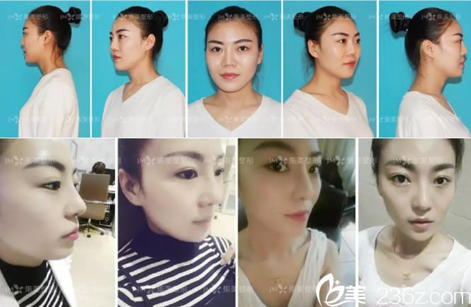 鼻修復手術(shù)前后全方位效果對比圖