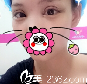 在重慶新銅雀臺做完雙眼皮2天照片