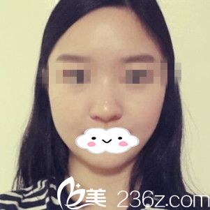 分享我在韓國車?yán)钹嵳稳ヮa脂墊瘦臉三個月秒變女神的過程