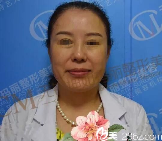 PRP脂肪填充術(shù)前衰老 PRP脂肪填充術(shù)前衰老