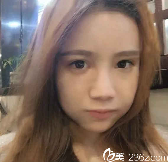 做鼻綜合整形手術(shù)前的肉鼻頭形象