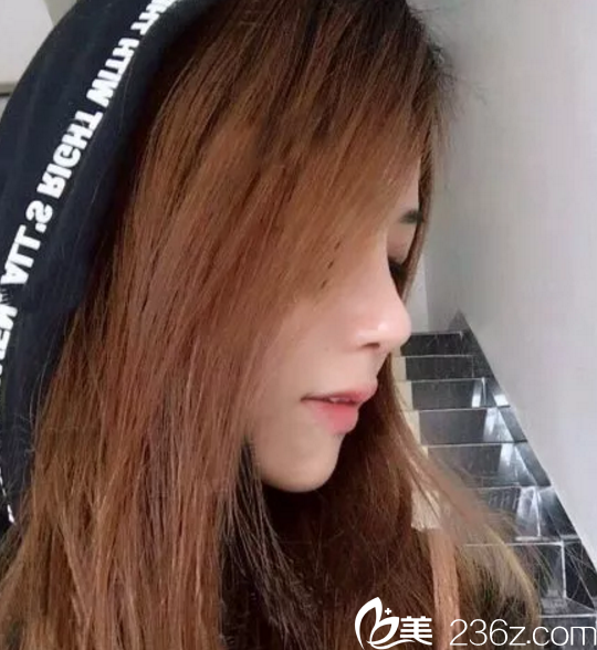 鼻綜合手術(shù)15天恢復(fù)效果圖