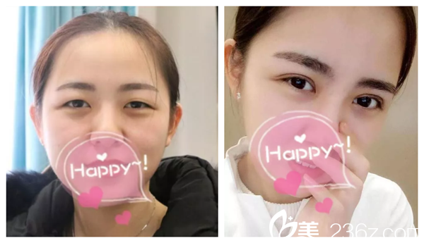 陳虹羽醫(yī)生雙眼皮案例