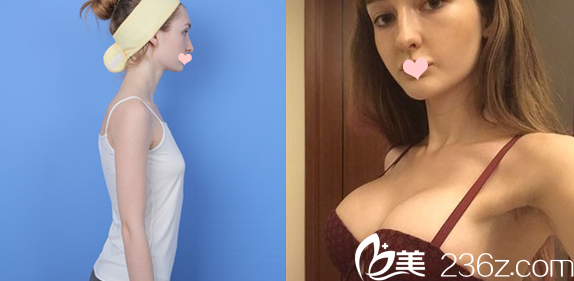 廣州曙光整形醫(yī)院孫婧假體隆胸