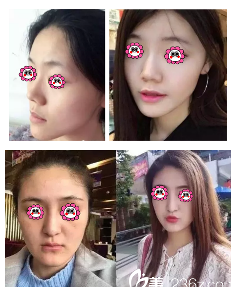 王培院長做自體脂肪填充面部案例