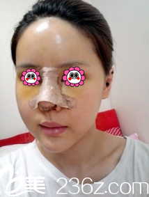 剛做完鼻子和面部填充的樣子