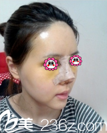 術(shù)后5天鼻子和面部慢慢恢復(fù)中