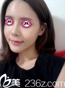 做完隆鼻和自體脂肪填充10天后的樣子