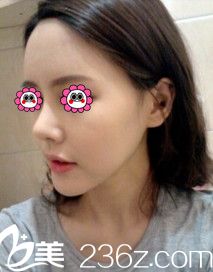 術(shù)后20天鼻子和面部正在恢復(fù)中