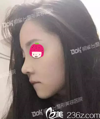 拆線(xiàn)了，第八天