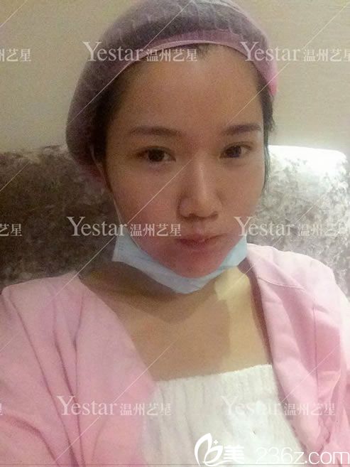 做鼻綜合整形手術(shù)前照片