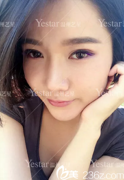 綜合隆鼻手術(shù)7天恢復照