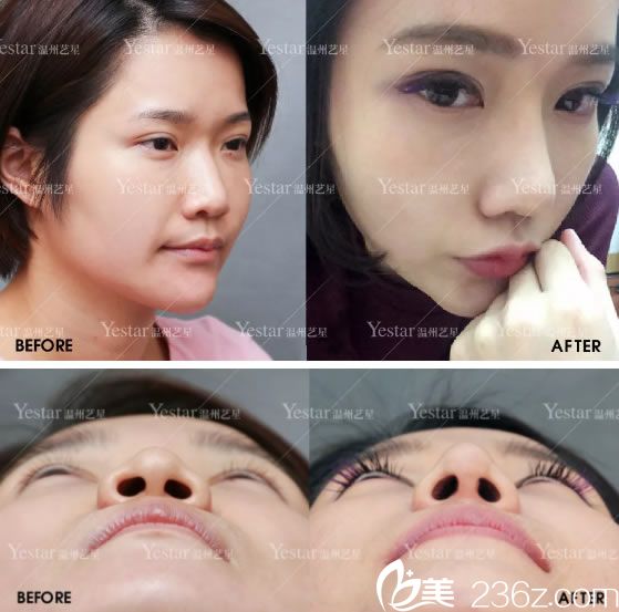 藝興綜合隆鼻手術(shù)前后<span style=