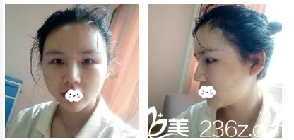 隆鼻6天拆線效果