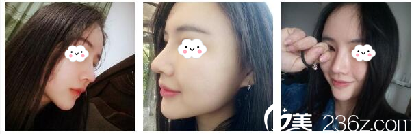 隆鼻術后20天恢復效果圖