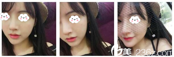 隆鼻術后20天自拍