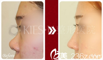 鼻部整形真人前后對(duì)比 鼻部整形真人前后對(duì)比