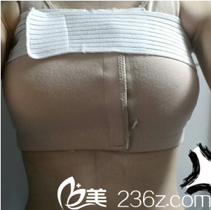 假體隆胸手術(shù)當(dāng)天