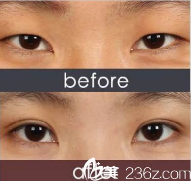 廈門華美陳運生雙眼皮案例 廈門華美陳運生雙眼皮案例