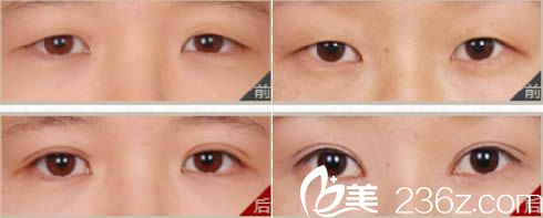 廈門陳運生主任上瞼下垂矯正案例圖 廈門陳運生主任上瞼下垂矯正案例圖