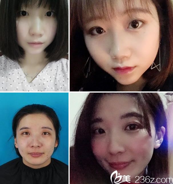 寧波雅韓劉成林全切雙眼皮案例