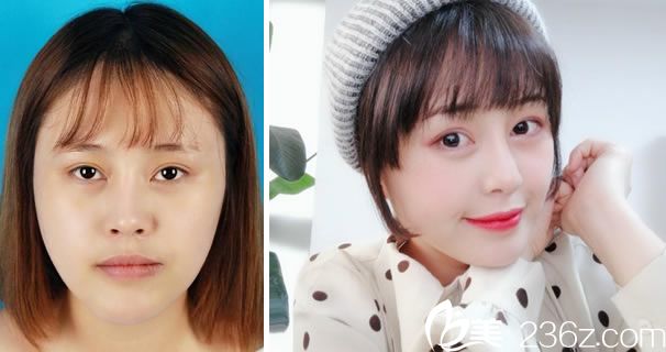 雙眼皮失敗在寧波雅韓修復(fù)效果