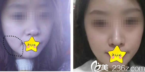 蘭州仁和面部線雕提升效果 蘭州仁和面部線雕提升效果