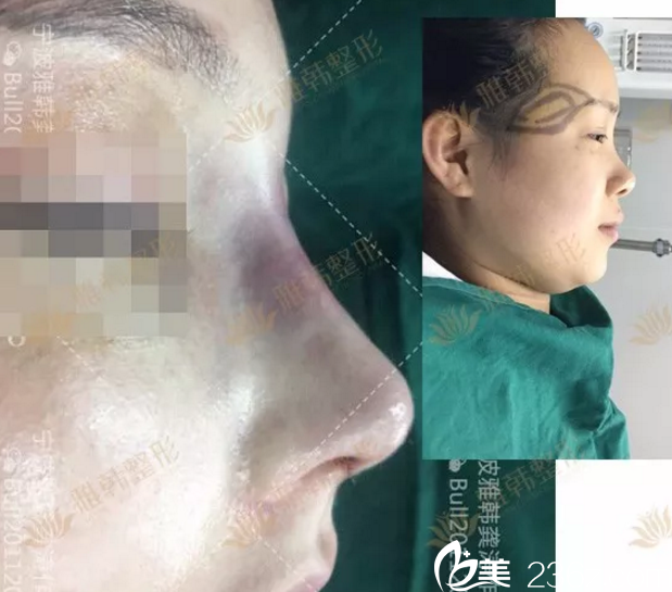 鼻綜合手術(shù)剛完成時對比效果 鼻綜合手術(shù)剛完成時對比效果