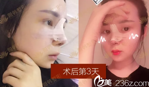 鼻綜合整形手術(shù)第3天恢復(fù)照 鼻綜合整形手術(shù)第3天恢復(fù)照