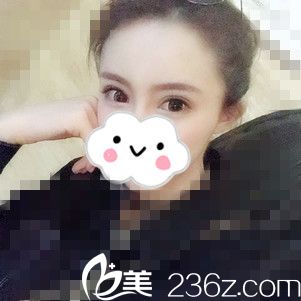 快看我在韓國麗妃整形外科做的雙眼皮一個(gè)月的恢復(fù)過程