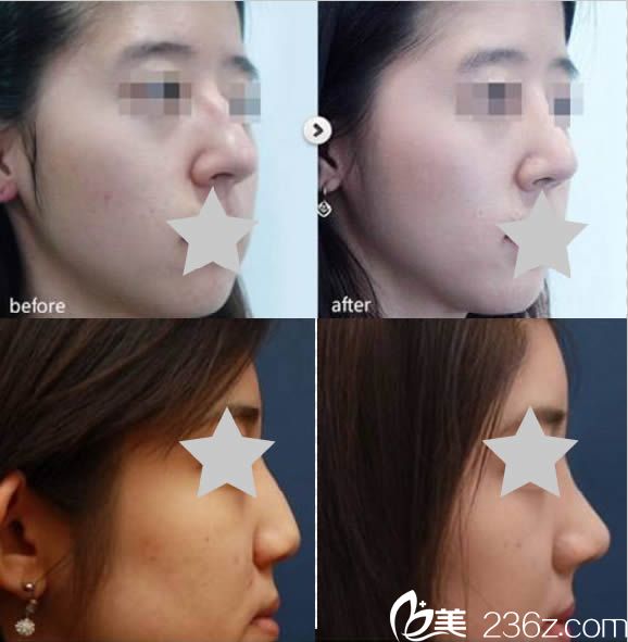 曾高做鼻子的圖片 曾高做鼻子的圖片