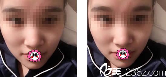 蘭州仁和整形醫(yī)院隆鼻前 蘭州仁和整形醫(yī)院隆鼻前