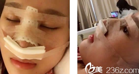 仁和<!--<i data=20240703-sp></i>-->自體肋軟骨隆鼻當(dāng)天 仁和<!--<i data=20240703-sp></i>-->自體肋軟骨隆鼻當(dāng)天