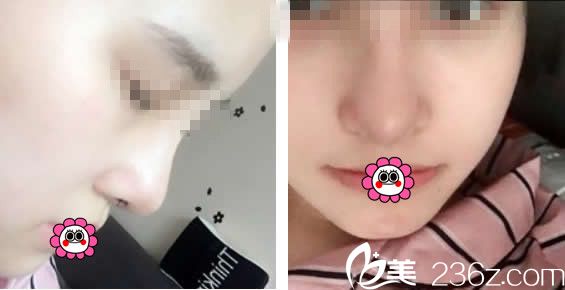 <!--<i data=20240703-sp></i>-->隆鼻案例 <!--<i data=20240703-sp></i>-->隆鼻案例