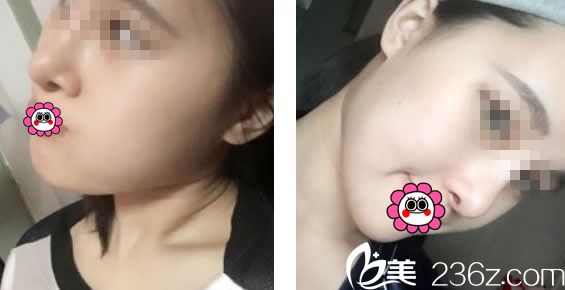 自體軟骨隆鼻13天效果 自體軟骨隆鼻13天效果