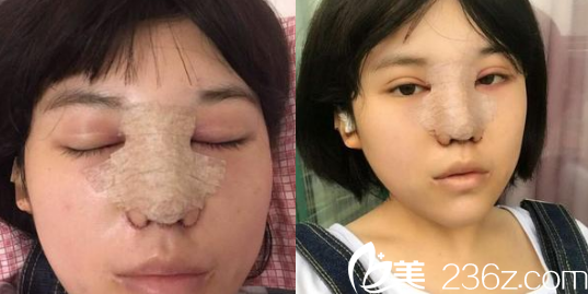 假體隆鼻后的樣子