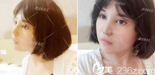 武漢洪山愛美匯醫(yī)院做的還不錯(cuò)，今天去拆線了