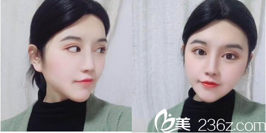 國慶節(jié)去武漢洪山愛美匯醫(yī)院找瞿敏醫(yī)生做了假體隆鼻