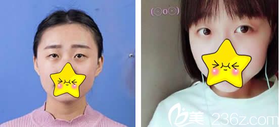 蘭州仁和整形醫(yī)院雙眼皮術(shù)前 蘭州仁和整形醫(yī)院雙眼皮術(shù)前