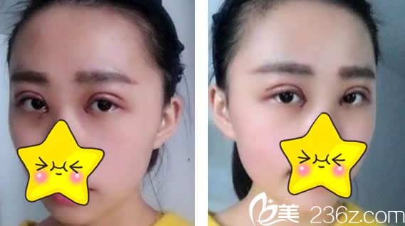 仁和王彥平切開法雙眼皮第四天 仁和王彥平切開法雙眼皮第四天