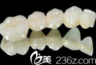 仿生美容冠 仿生美容冠