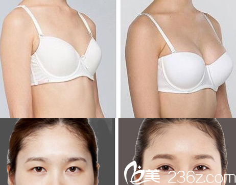 重慶好美假體隆胸、全切無(wú)痕雙眼皮